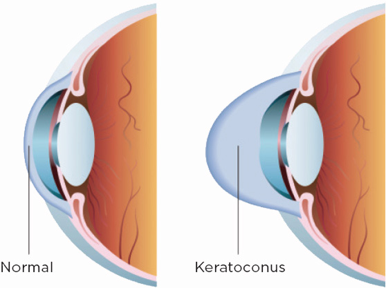 Korneal Crosslinking